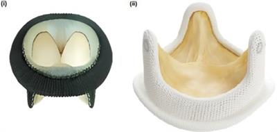 Case report: Transcatheter tricuspid valve-in-valve implantation using novel balloon-expandable aortic valve with 1 year follow-up